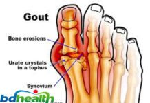 গেঁটে বাত,gout